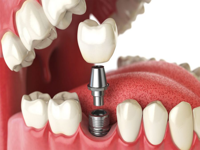 corone-dentali