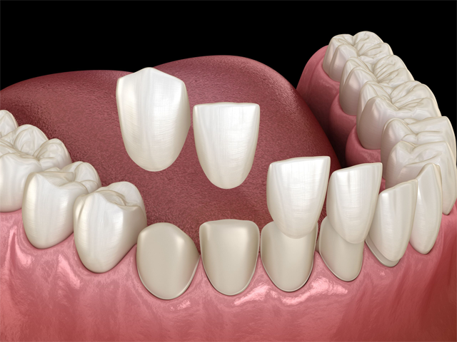 dental-bonding