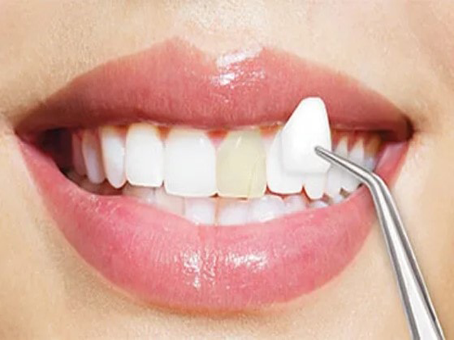 faccette-dentali