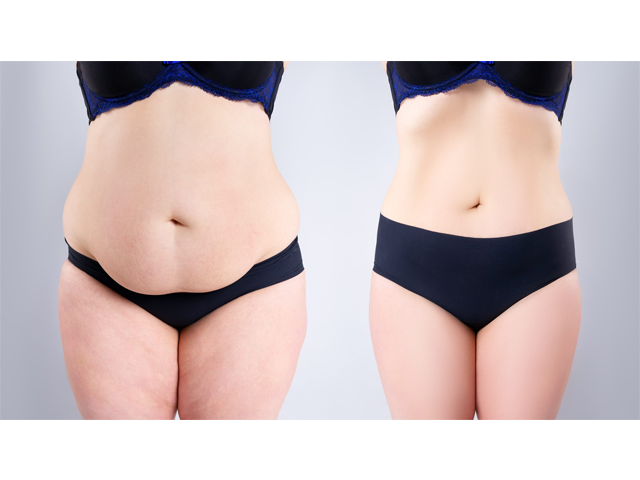 tummy-tuck